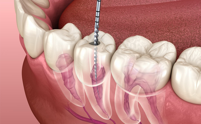 Root Canal Treatment in Whitefield 