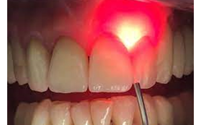 Laser Dentistry in Whitefield