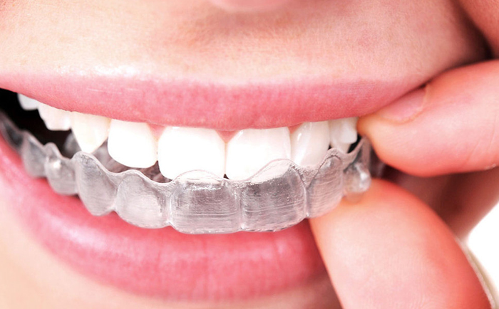 Invisalign Dental Clinic  in whitefield